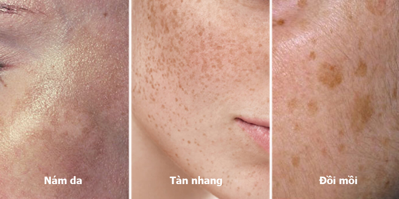Chăm Sóc Da và Trị Nám Tại Hồ Chí Minh: Spa Trị Nám và Sự Lựa Chọn Thông Minh Cho Làn Da Tươi Trẻ