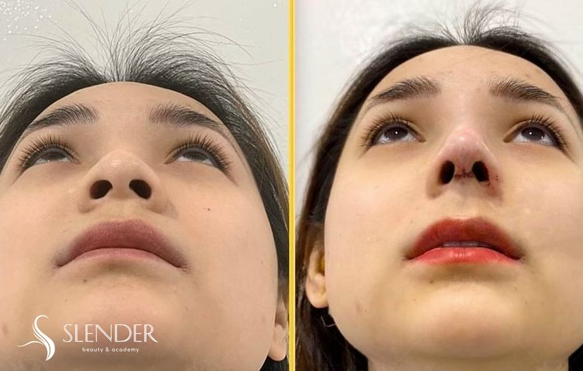 Mức Giá Trung Bình Cho Việc Nâng Một Chiếc Mũi Đẹp Là Bao Nhiêu ?