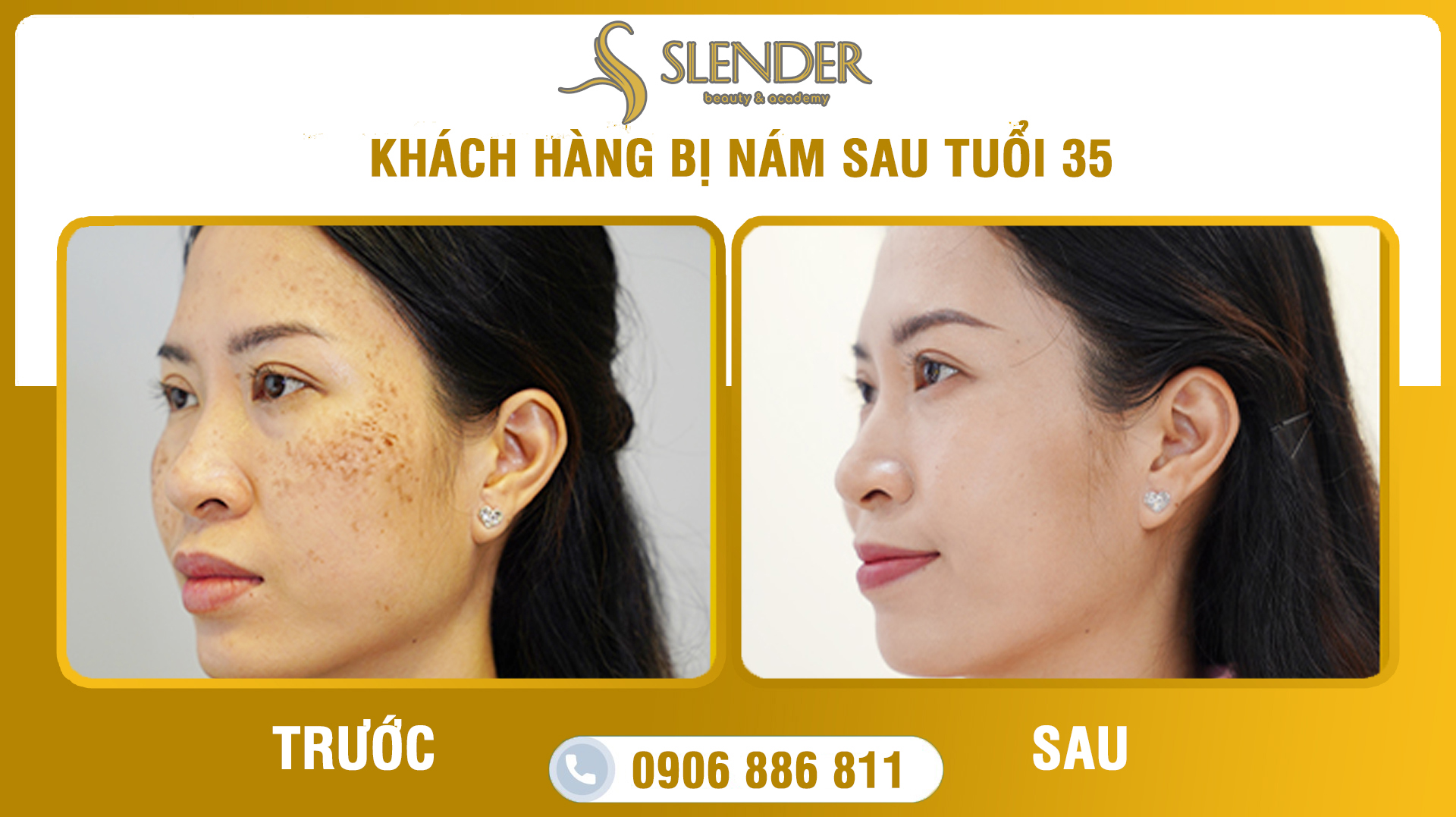 Chữa Nám Da Bằng Laser: Sự Lựa Chọn Hiện Đại Cho Làn Da Hoàn Hảo