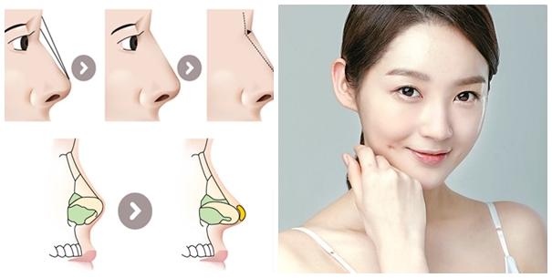 Nâng Mũi Sụn USA Giá Bao Nhiêu?, Nâng Mũi Tại Slender Beauty Uy Tín Giá Tốt Nhất